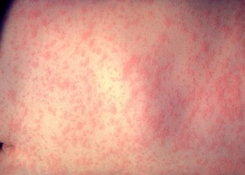 Beneficiile vaccinului împotriva rujeolei