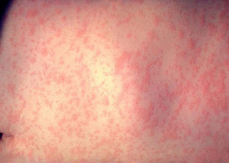 Beneficiile vaccinului împotriva rujeolei